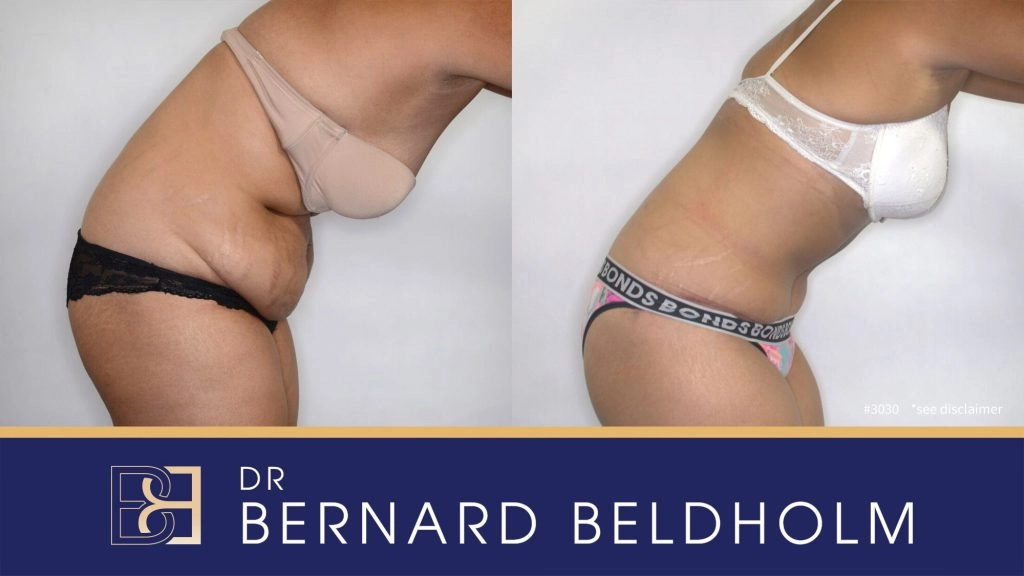 Patient 3030 - Before & After Abdominoplasty