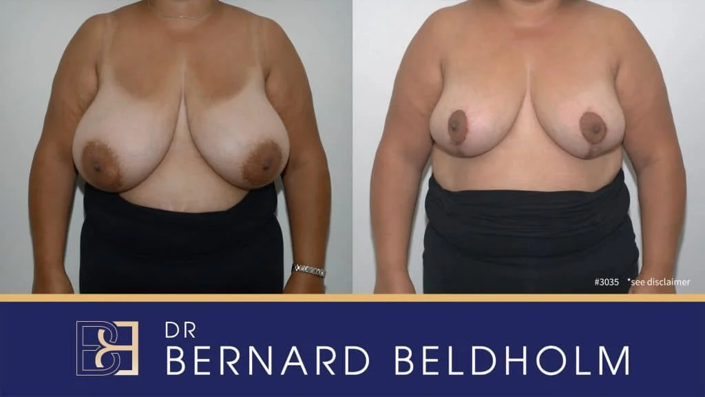 Patient 3035 - Before & After - Breast Reduction