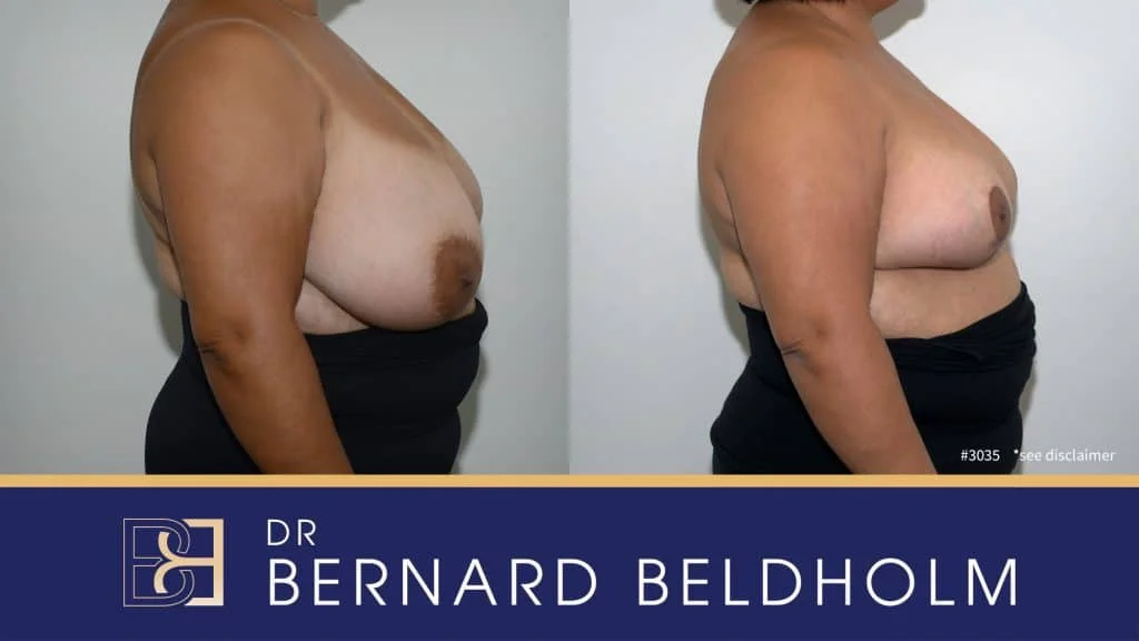 Patient 3035 - Before & After - Breast Reduction