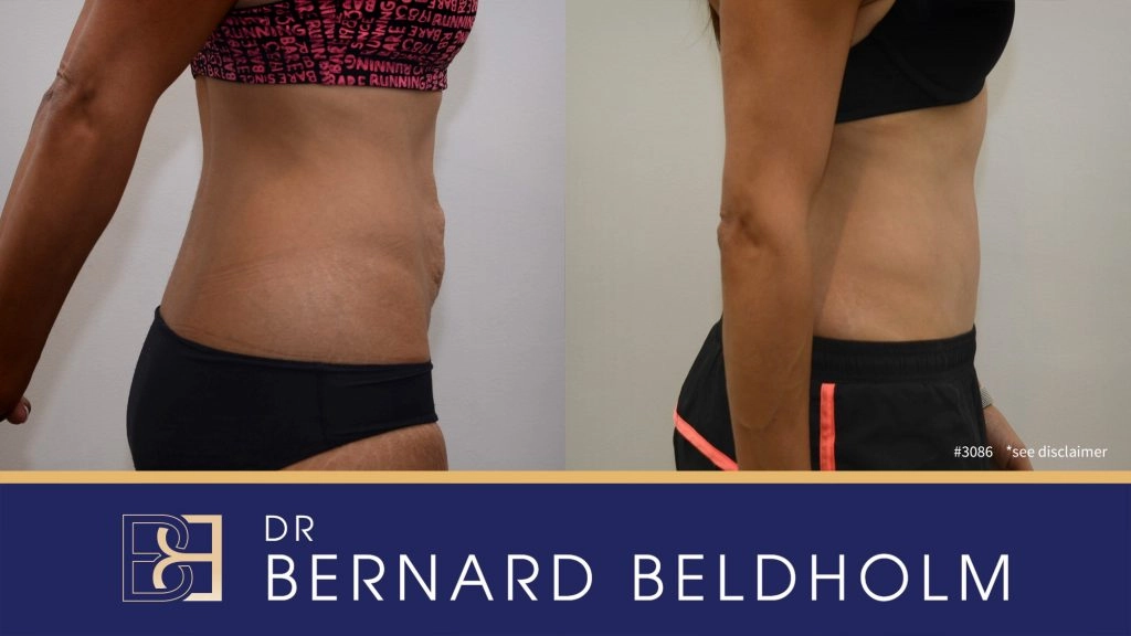 Patient 3086 - Before & After Abdominoplasty