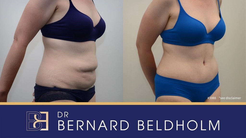 Patient 3088 - Before & After Abdominoplasty