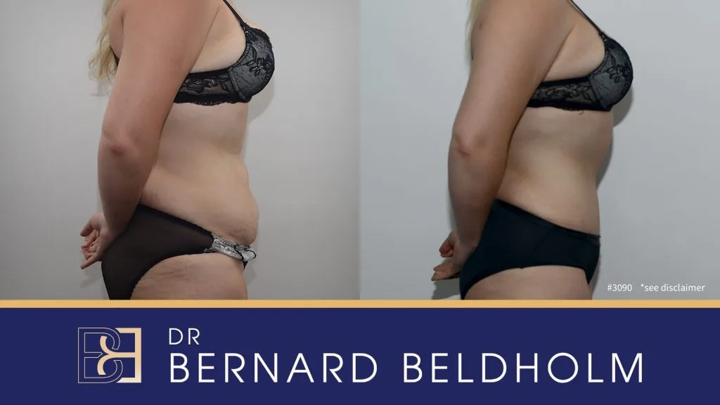 Patient 3090 - Before & After Abdominoplasty