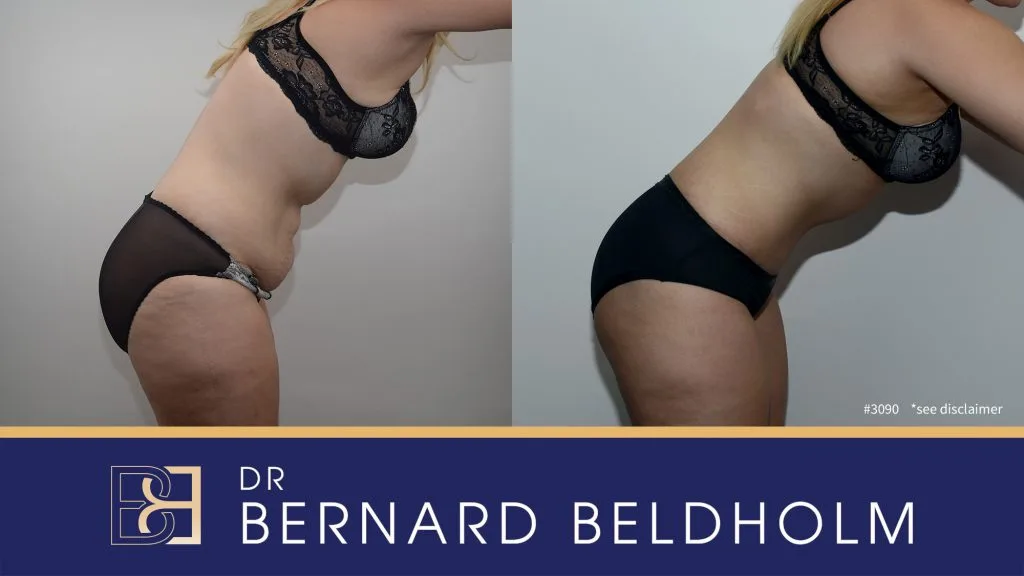 Patient 3090 - Before & After Abdominoplasty