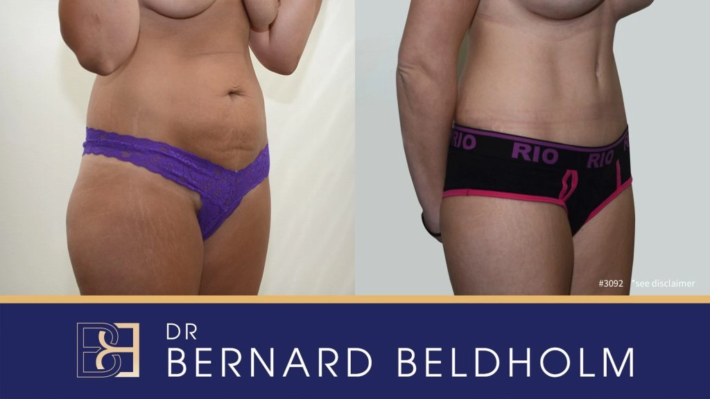 Patient 3092 - Before & After Abdominoplasty