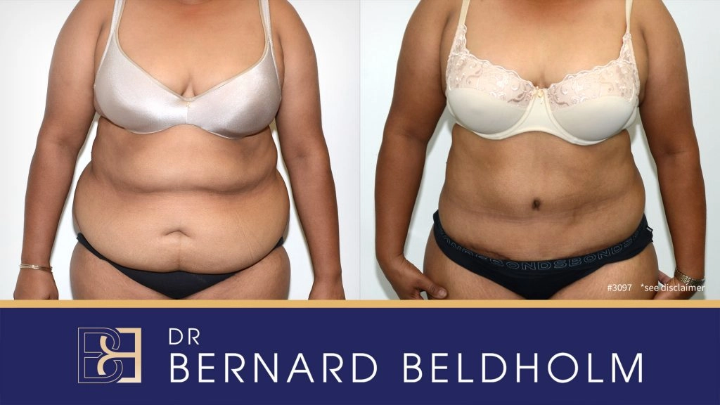 Patient 3097 - Before & After Abdominoplasty