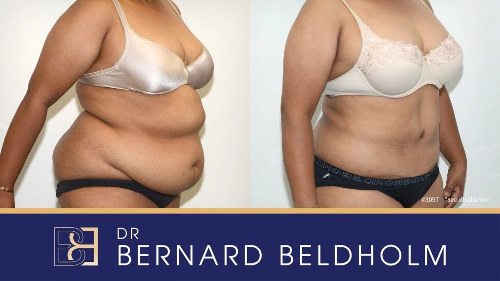 Patient 3097 - Before & After Abdominoplasty