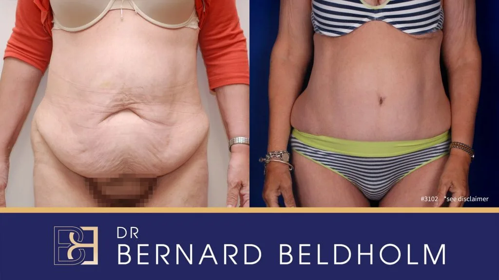 Patient 3102 - Before & After Abdominoplasty