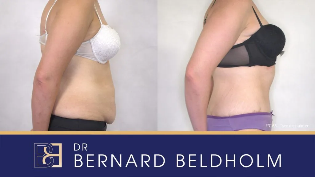 Patient 3166 - Before & After Abdominoplasty