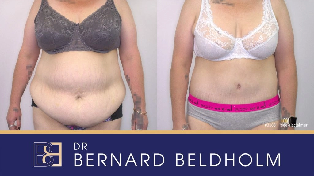 Patient 3168 - Before & After Abdominoplasty