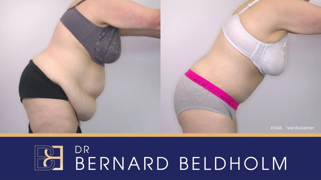 Patient 3168 - Before & After Abdominoplasty