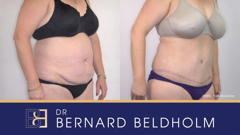 Patient 4006 - Before & After Abdominoplasty
