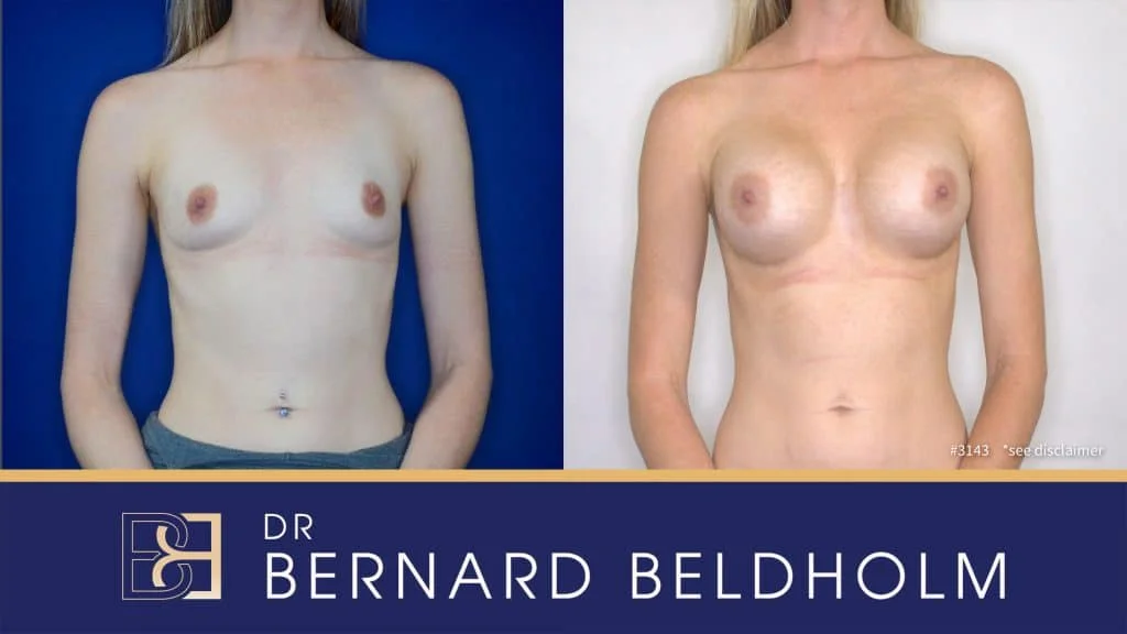 Teardrop - Breast Implants - 400cc to 499cc - Before & After