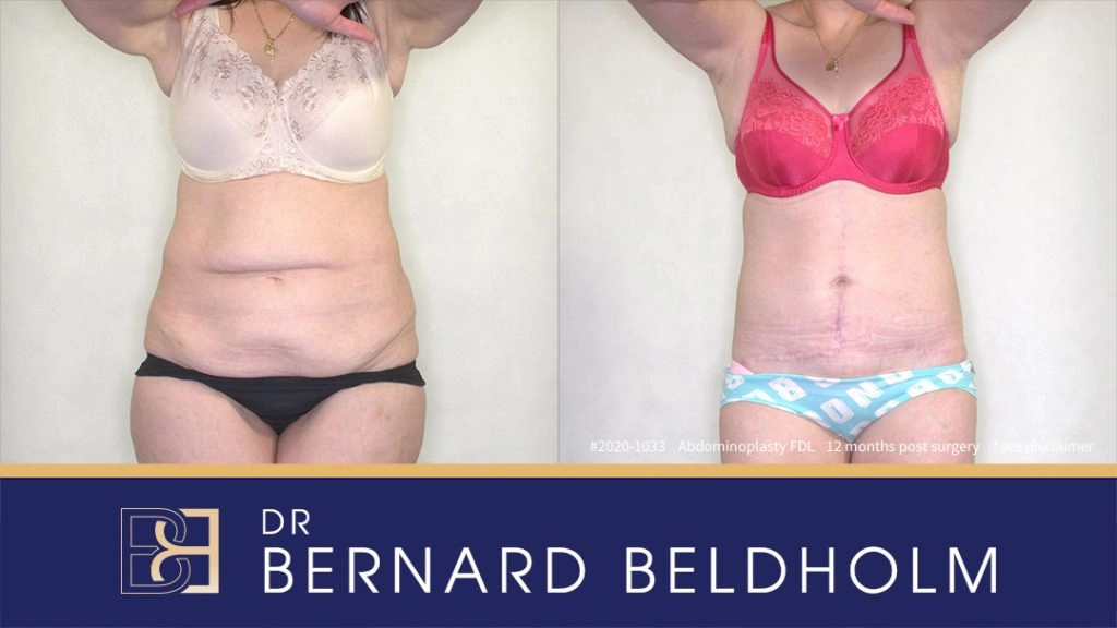 Patient 2020-1033 Tummy Tuck - Before & After