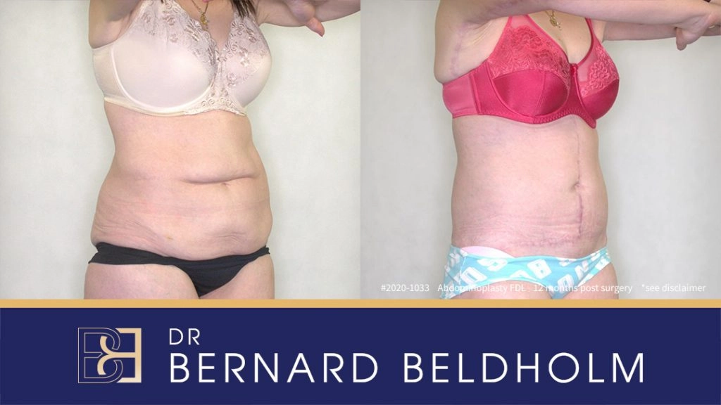 Patient 2020-1033 Tummy Tuck - Before & After