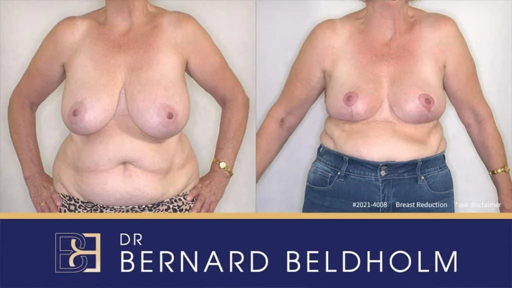 Patient 2021-4008 - Breast Reduction - Before& After