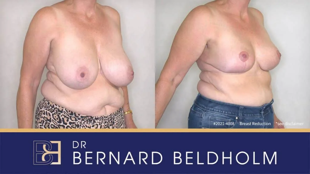 Patient 2021-4008 - Breast Reduction - Before & After