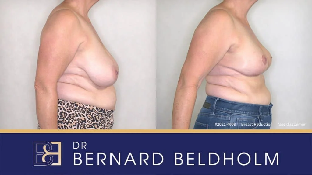 Patient 2021-4008 - Breast Reduction - Before & After