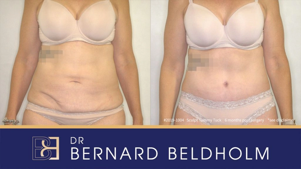 Patient 2019-1004 - Sculpt Tummy Tuck - Before & After