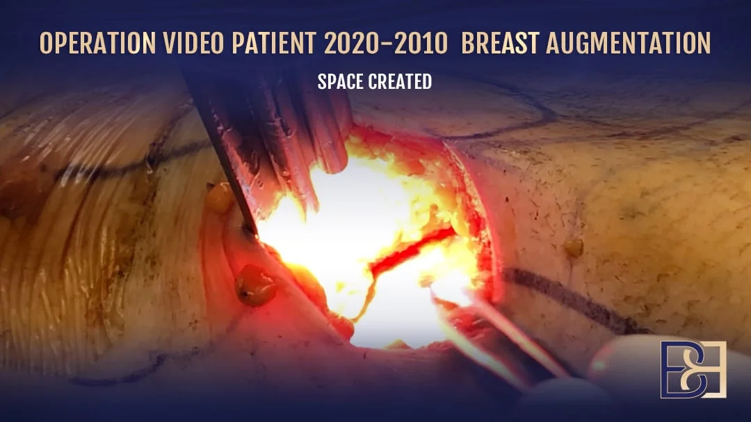 Patient 2020-2010 - Breast Augmentation
