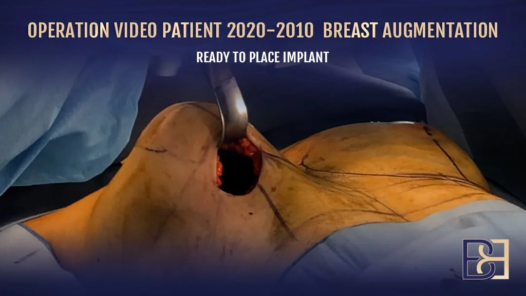 Patient 2020-2010 - Breast Augmentation