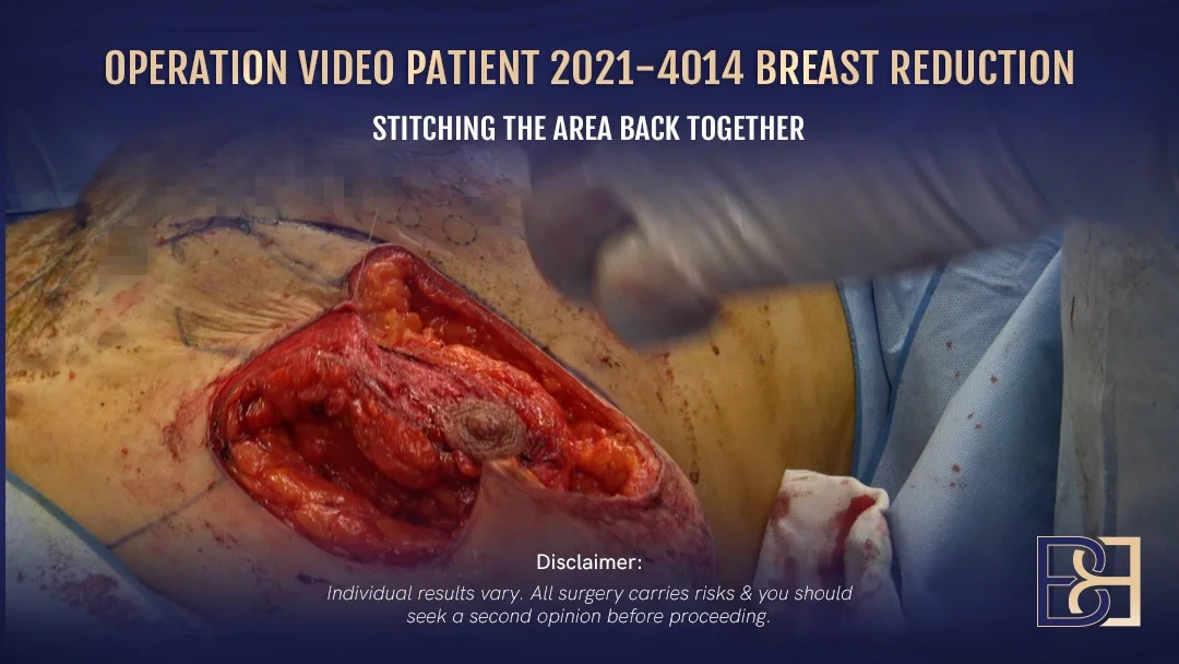 Patient 2021-4014 - Breast Reduction