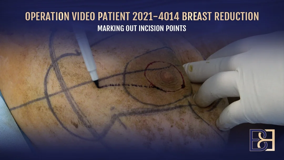 Patient 2021-4014 - Breast Reduction