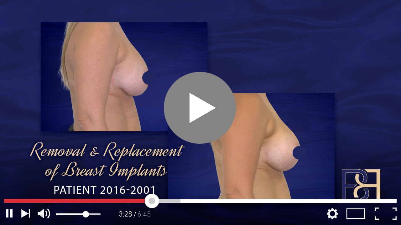 Youtube Thumbnail Patient 2016 2001 Removal Replacement of Implant