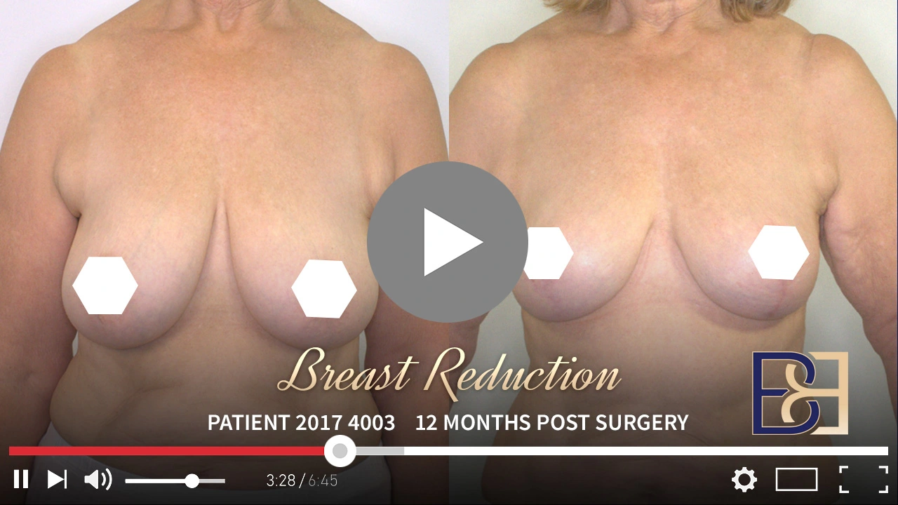 Patient 2017-4003 - Breast Reduction - Before & After - Featured Image