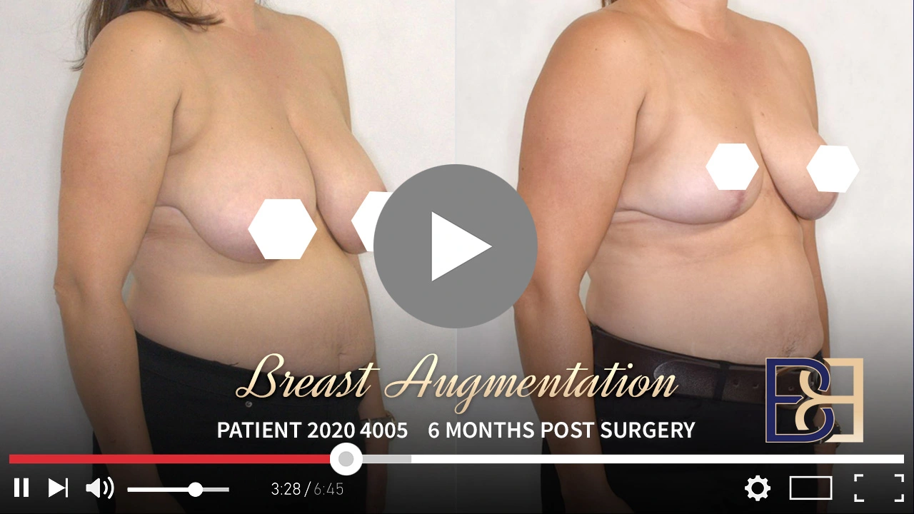 Patient 2020-4005 - Breast Reduction - Before & After - Featured Image