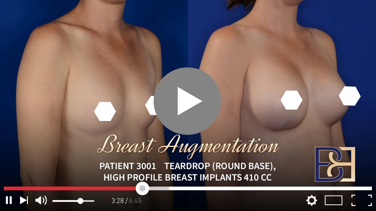 Patient 3001 - Breast Augmentation - Featured Image