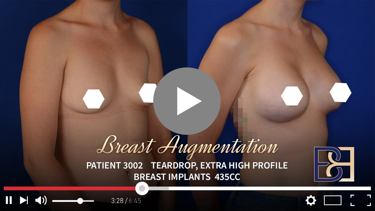 Patient 3002 - Breast Augmentation - Featured Image