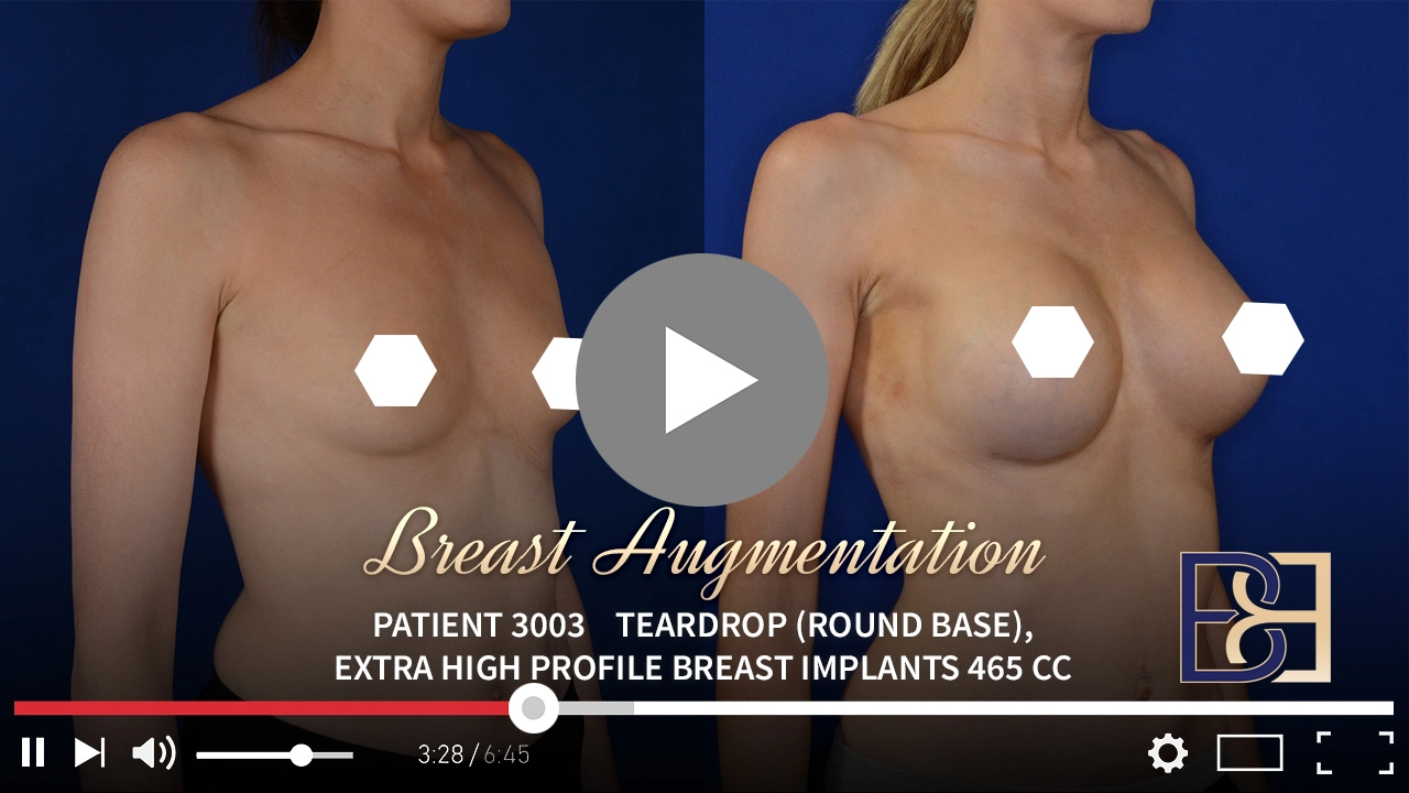 Patient 3003 - Breast Augmentation - Featured Image