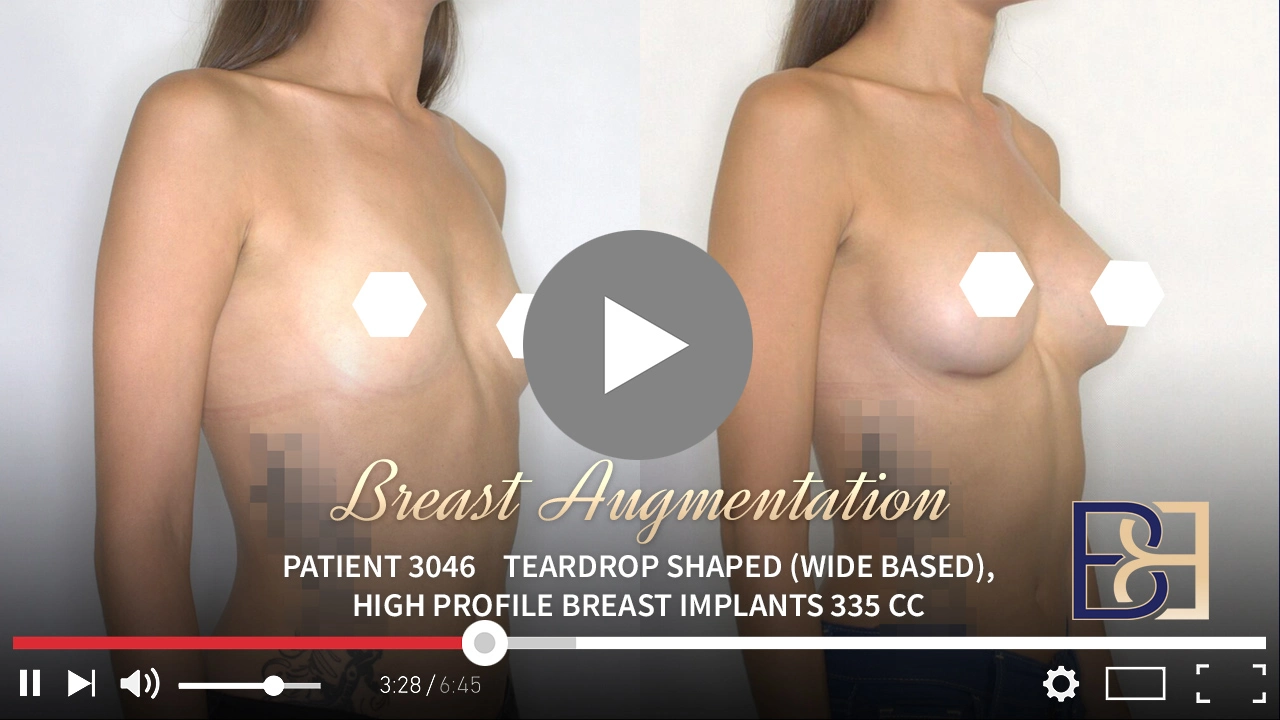Patient 3046 - Breast Augmentation - Feat