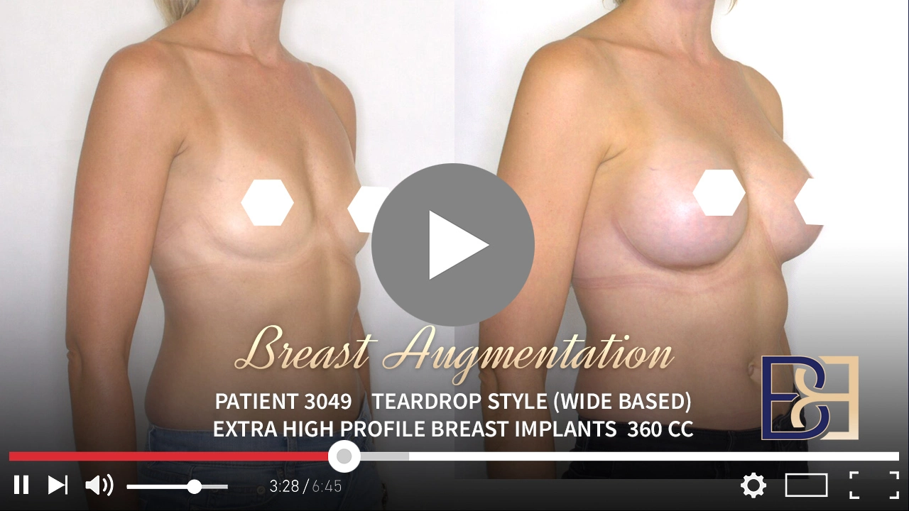 Patient 3049 - Breast Augmentation