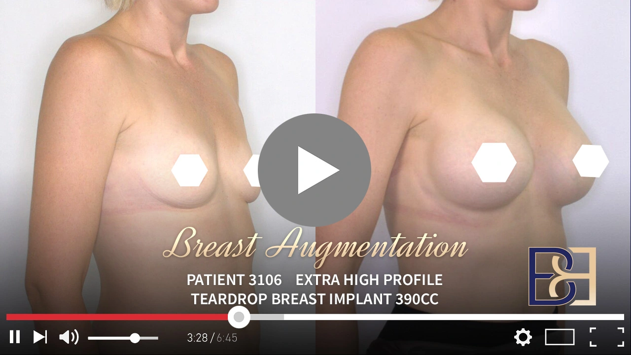 Patient 3106 - Breast Augmentation Feat