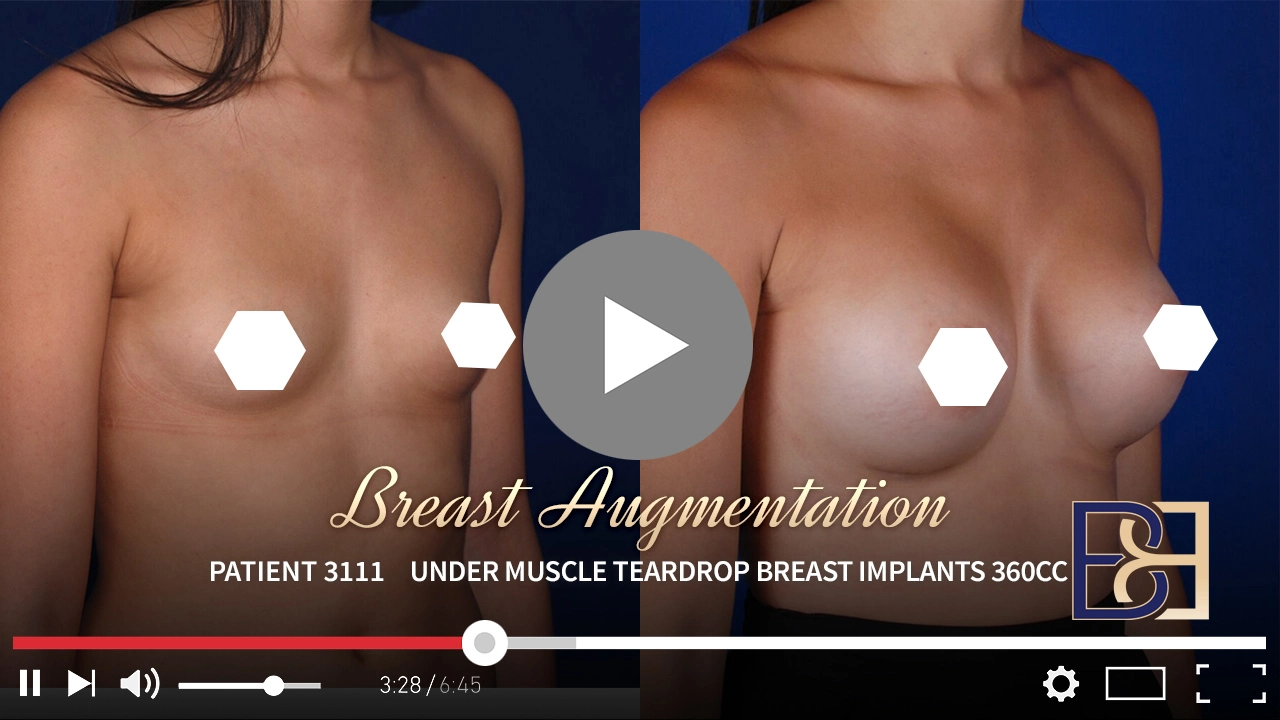 Patient 3111 - Breast Augmentation