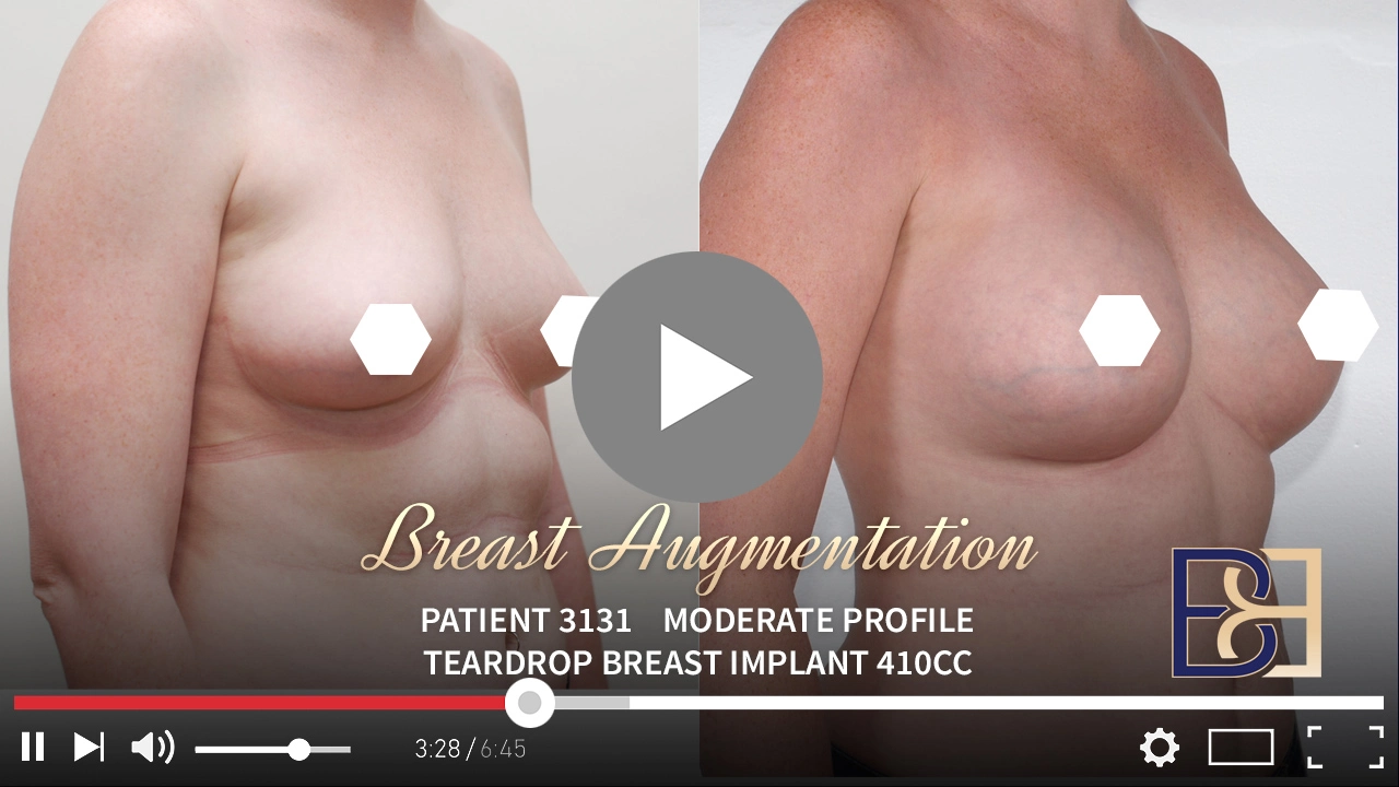 Patient 3131 - Breast Augmentation - Featured Image