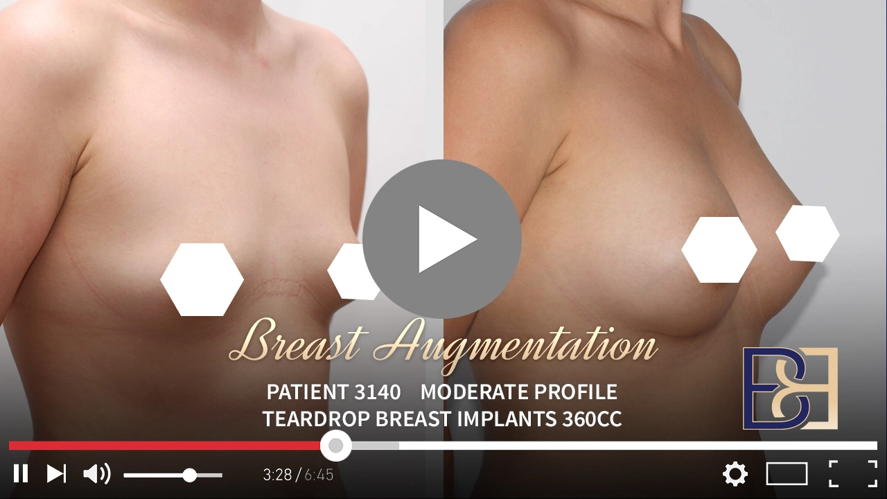 Patient 3140 - Breast Augmentation