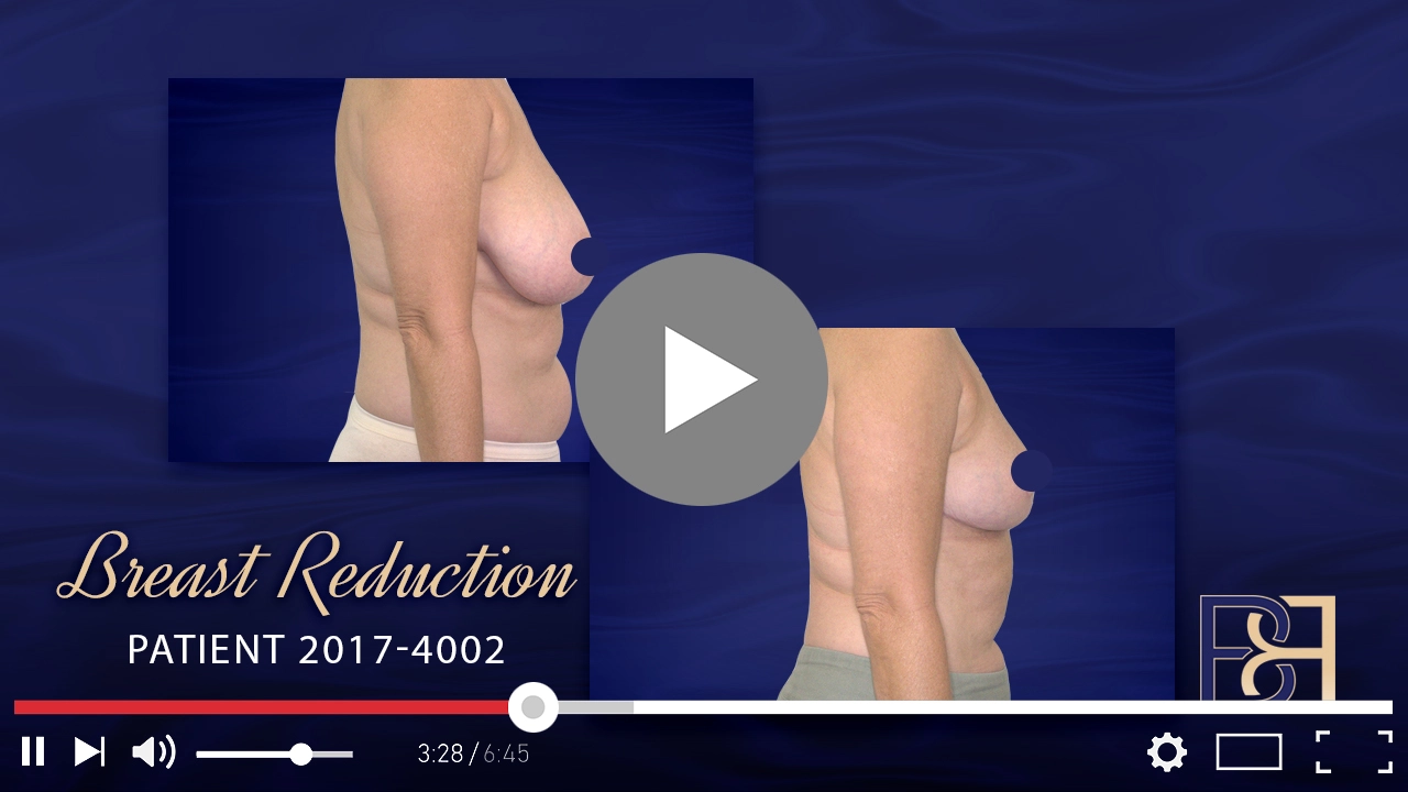 Patient 2017-4002 - Breast Reduction - Featured Image