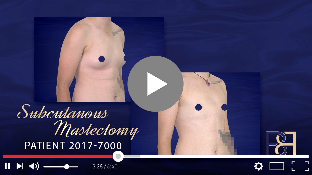 Patient 2017-7000 - Transgender Female to Male - Subcutaneous Mastectomy