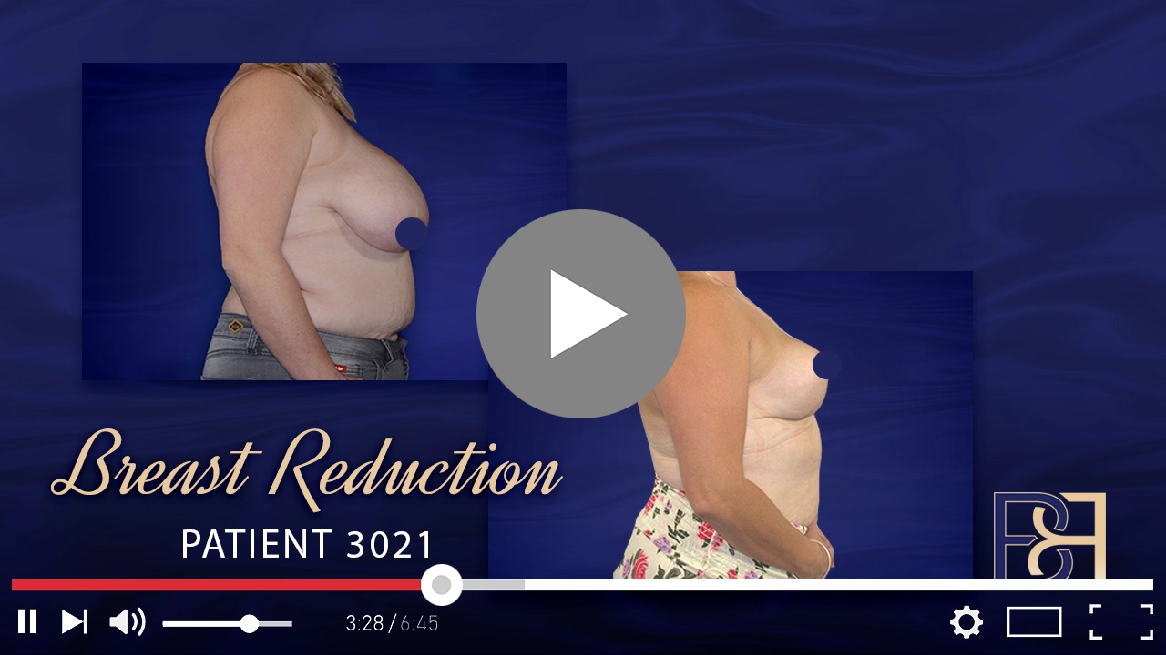 Patient 3021 - Breast Augmentation - Featured Image