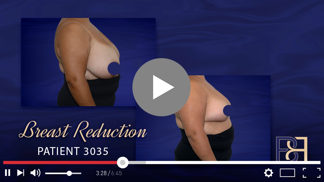 Patient 3035 - Before & After - Breast Reduction - Featured Image