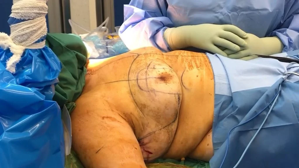 Auto Augmentation Breast Lift Surgery Preparation Pre-operative Marking by Dr. Bernard Beldholm