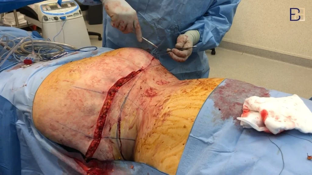 Belt Lipectomy Closing the Back Incision by Dr. Bernard Beldholm