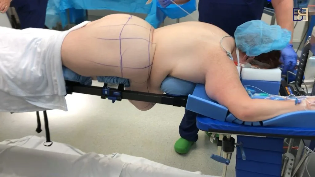 Belt Lipectomy Positioning you on the operating table by Dr. Bernard Beldholm