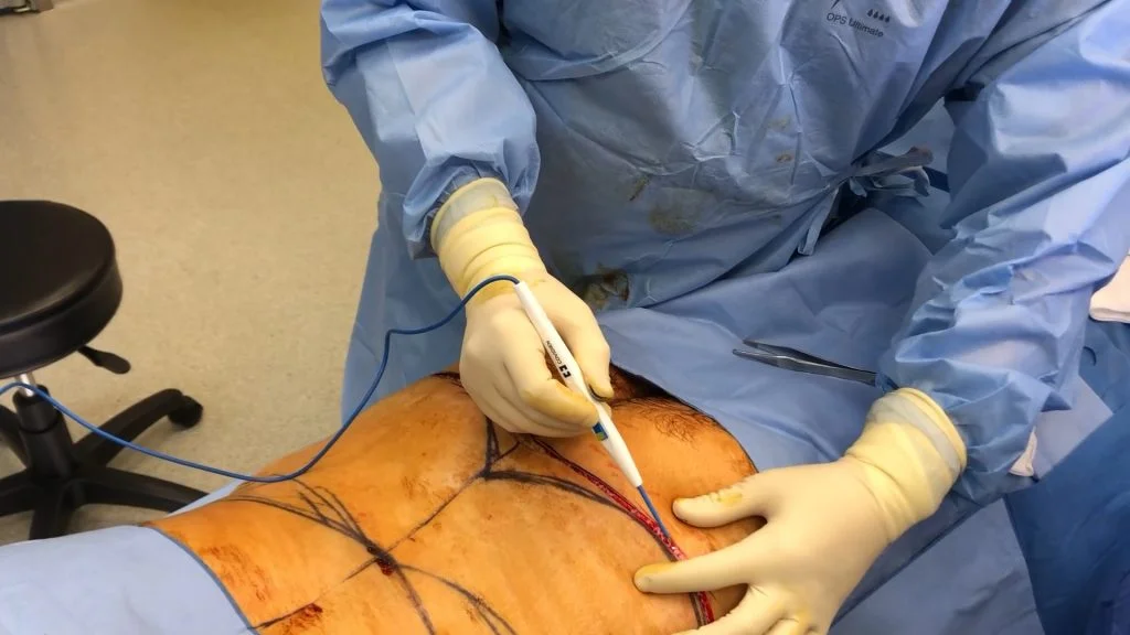 Belt Lipectomy Surgery Without Liposuction Incision by Dr. Bernard Beldholm