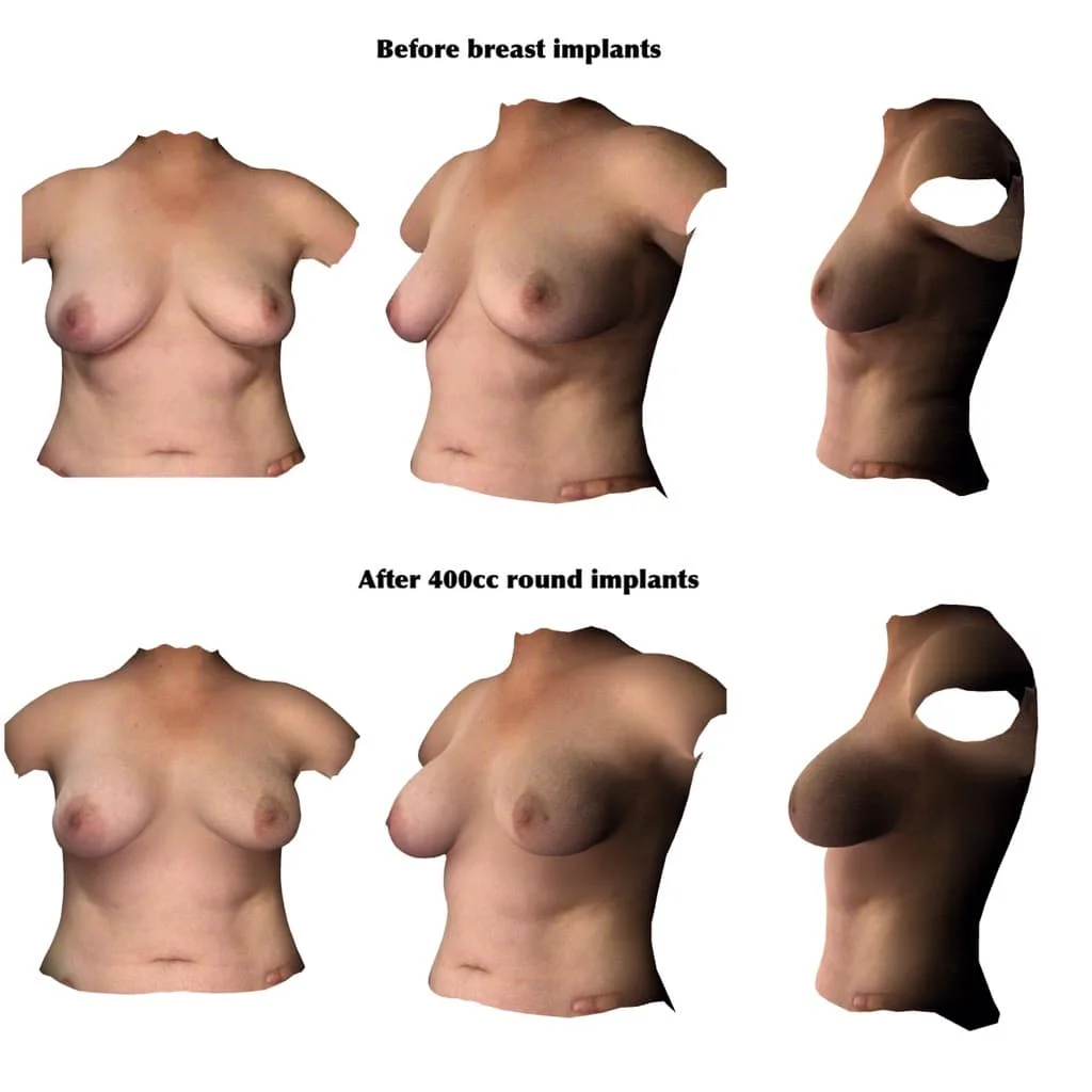 Breast Implant Before Breast Augmentation 400cc Round 2