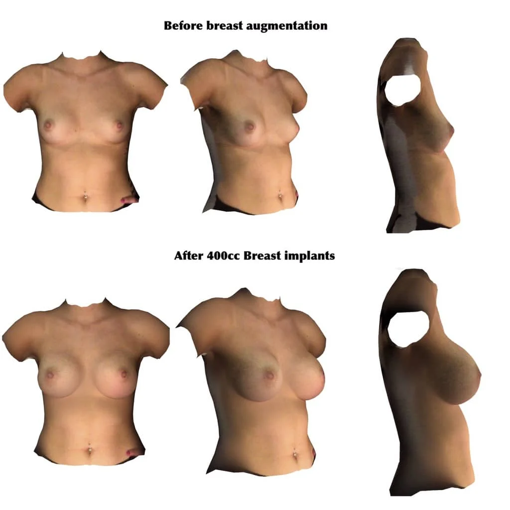 Breast Implant Before Breast Augmentation 400cc