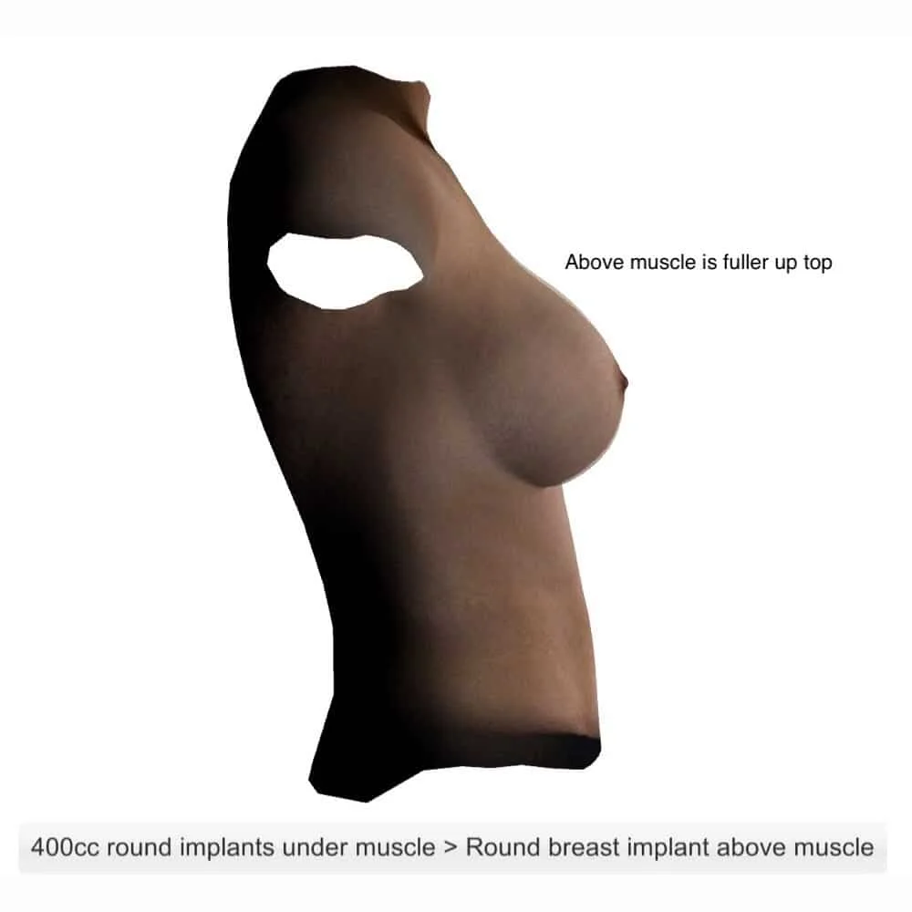 Breast Implant Diff Types 2
