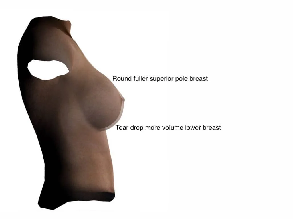 Breast Implant Diff Types